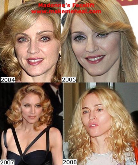 Speciālisti saskaitījuši Madonnas plastiskās operācijas (FOTO) (Bilde 3)