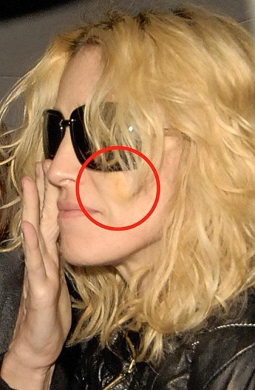 Speciālisti saskaitījuši Madonnas plastiskās operācijas (FOTO) (Bilde 4)