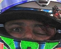 F1 pilotam Masam trasē izkritusī detaļa pārsitusi seju (FOTO)