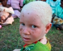 Melnādaino pāra ģimenē piedzimuši trīs albīni